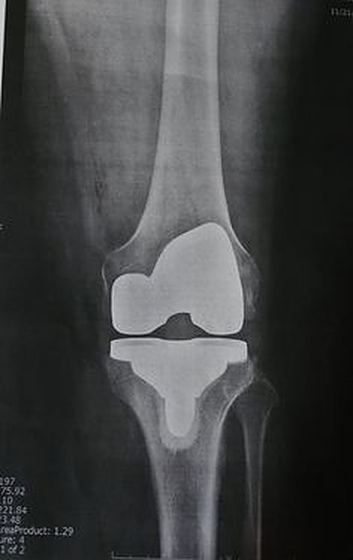 X-ray of a knee replacement