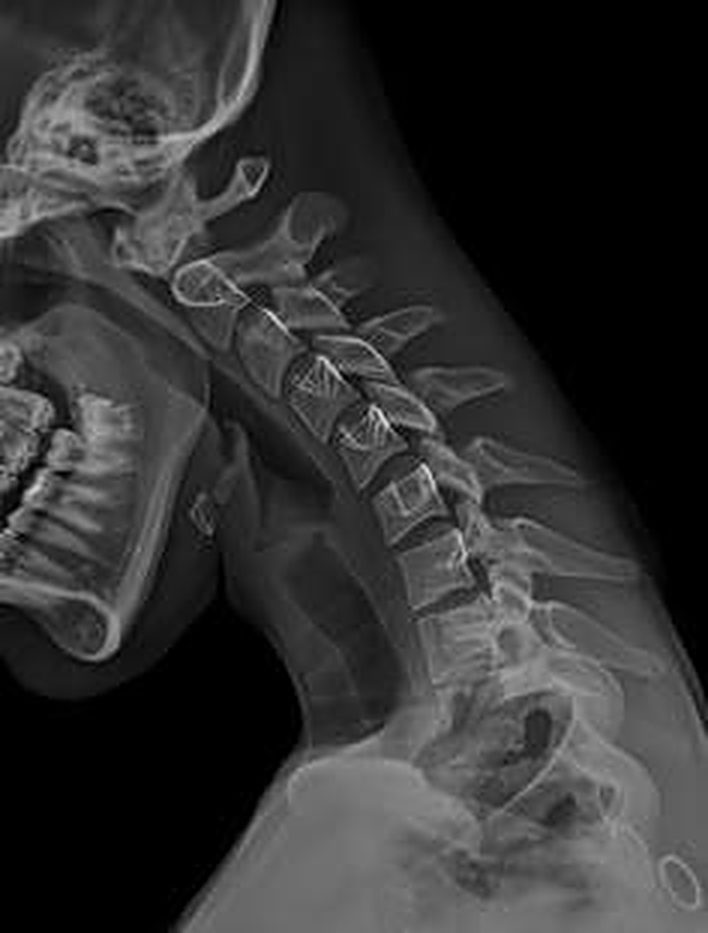 Side X-ray of the skull and cervical spine