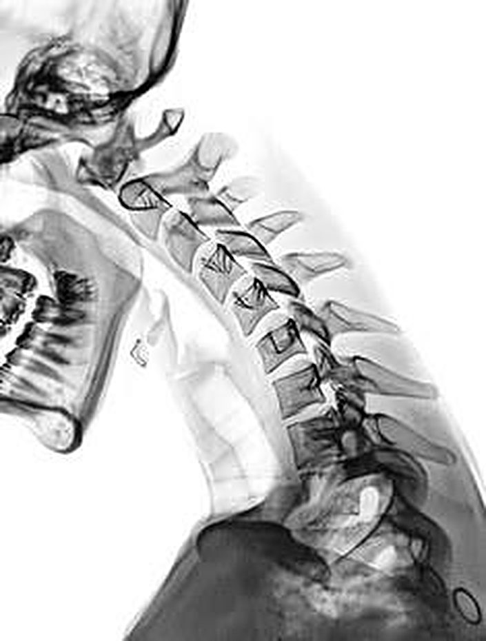 The same X-ray, inverted